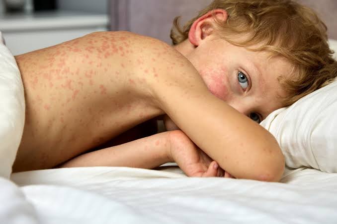 Measles
