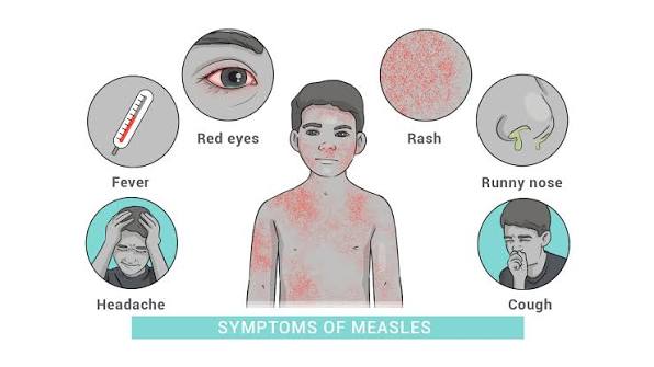 Measles